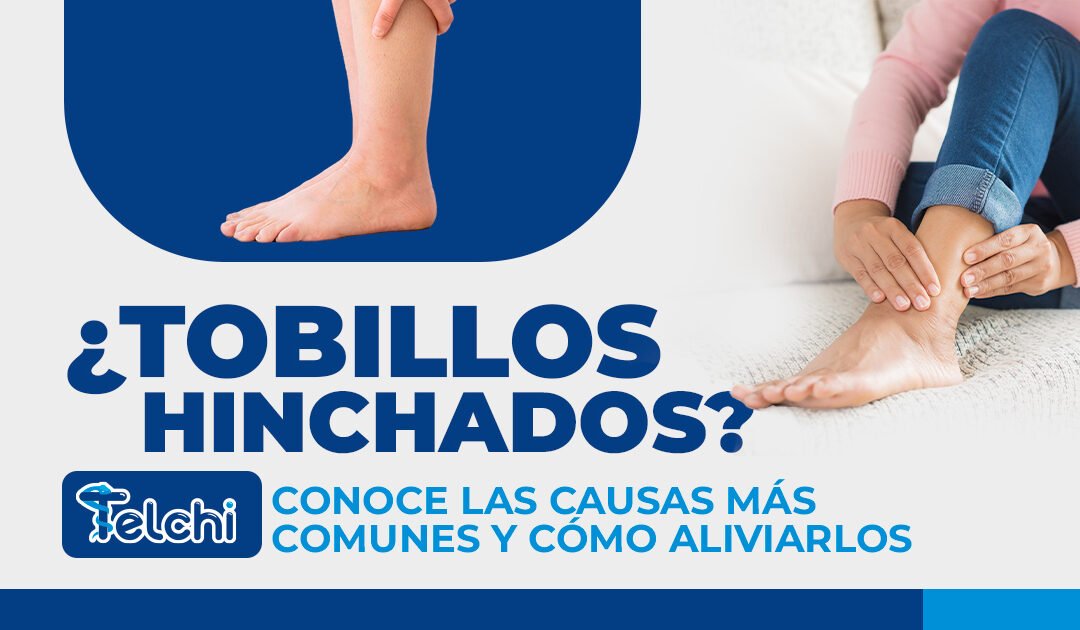¿Tienes los tobillos hinchados? Conoce las causas más comunes y cómo aliviarlos
